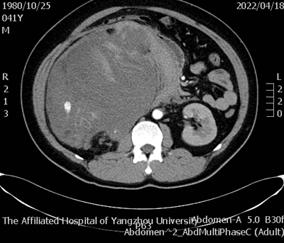 1651115699120058.png 术前腹部增强CT_副本.png